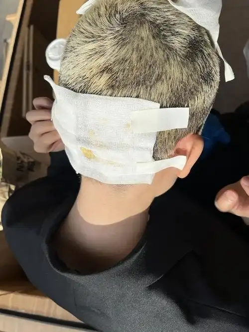 李先生漂染头发后头皮二度烧伤如今,"满目疮痍"的头皮,让李先生有