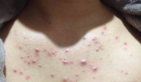 皮脂腺大量分泌,痤疮丙酸杆菌增殖,毛囊皮脂腺导管的角化异常及炎症等