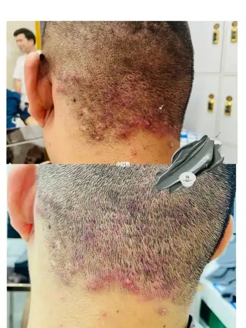 头皮毛囊炎刷冰川泥呀_冰川_毛囊炎_泥面膜_消炎杀菌_大学生_冰川泥膜