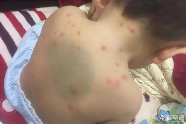 儿童出现水痘初期症状图片分享附正确护理方式
