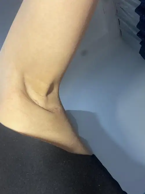 做的腋下切口.但是右边切口_圈子-新氧美容整形