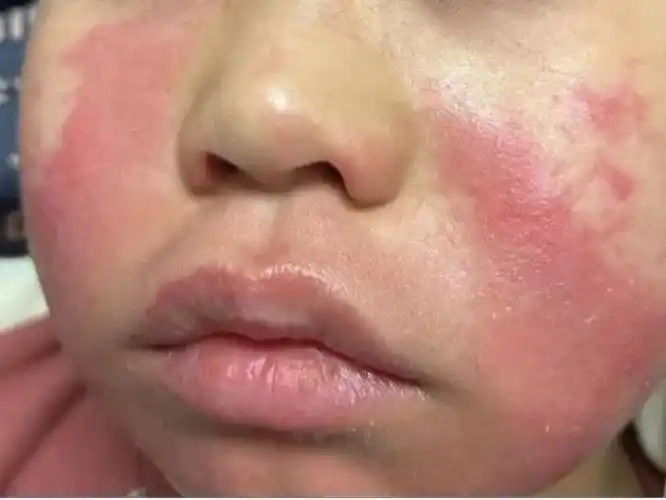 吃芒果吃出了皮肤病芒果到底该怎么吃