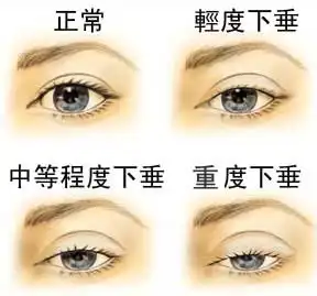 在安徽合肥做个上睑下垂手术需要多少钱