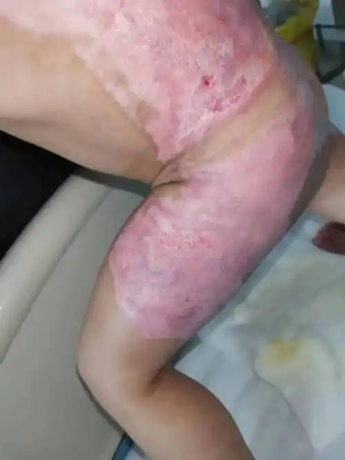 科普知识小儿烫伤是由于幼儿期儿童好奇心强,活动稳定性差,回避反应