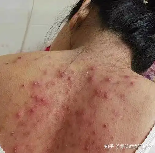 背部痘痘很不友好