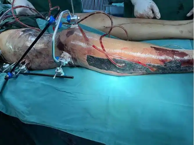 医生迎难而上成功保肢_患者_手术室_大腿