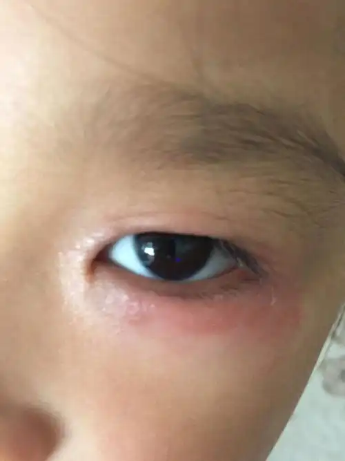 5岁小孩从1岁多开始就眼睛周围红红的脱皮不痒不痛,隔三四天就开始红