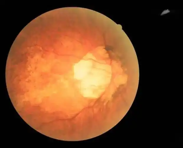 高度近视有多可怕你所不知道的危害必须关注