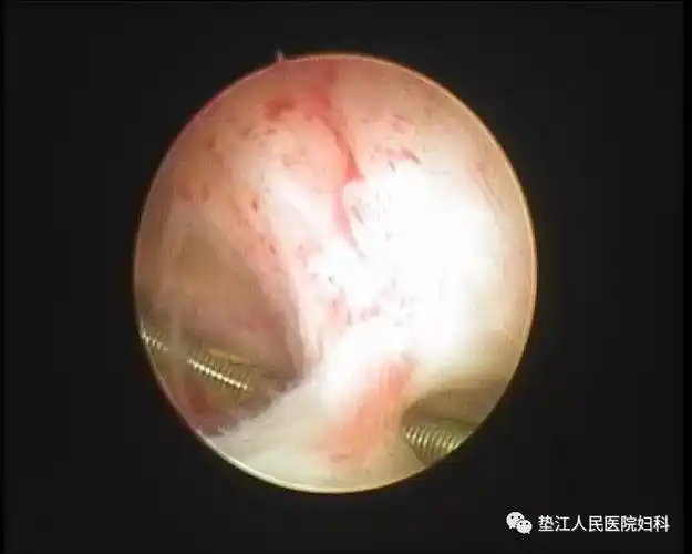 节育环"长进肉里了",垫江县人民医院妇科有办法