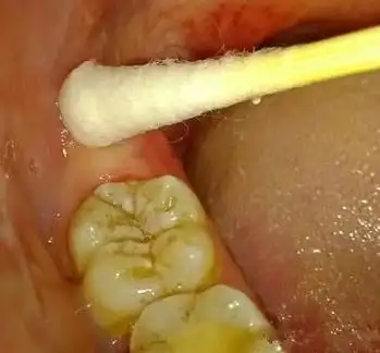 什么时候拔智齿合适