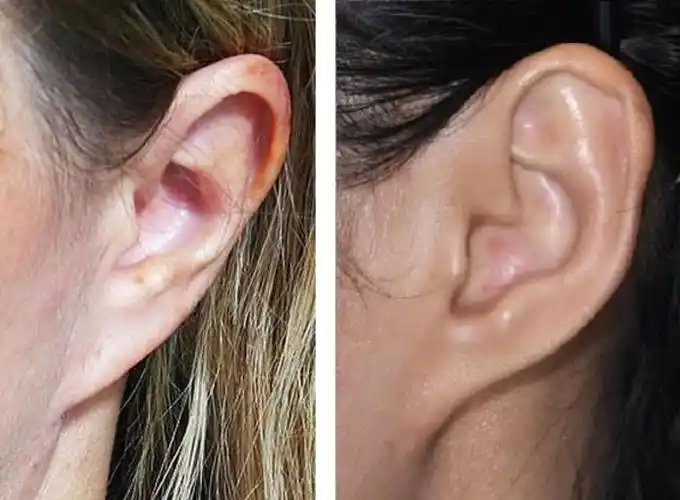 常见先天性耳廓畸形_郭荣医生文章_上海市东方医院北院-微医