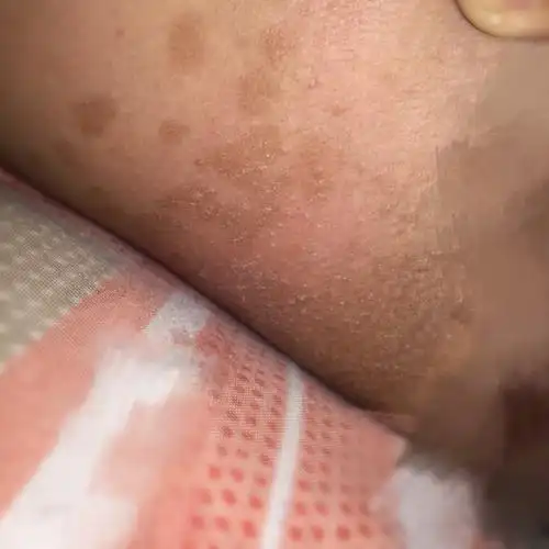 怀孕2个月.大腿和手臂处长了貌似花斑藓的东西,有时候会痒.