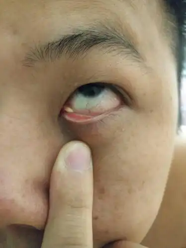 眼球内下角长了一个乳白色的东西,请问是啥?