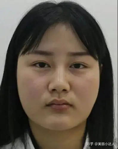 不想做大饼脸去做了面部吸脂