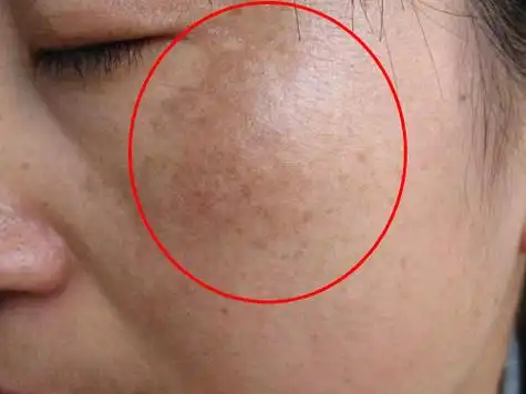 才30岁脸色暗沉一片色斑太难看,传统草药加蛋清,排毒淡斑提亮