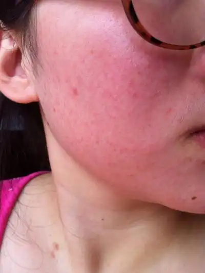 敏感肌肤脸上红血丝反复,是因为你没有掌握这一点