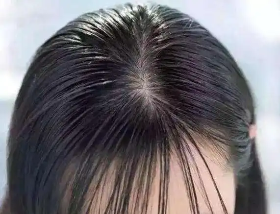 二,油腻的头发头上有螨虫,首先头皮会经常感到很痒,头皮会有痒甚至