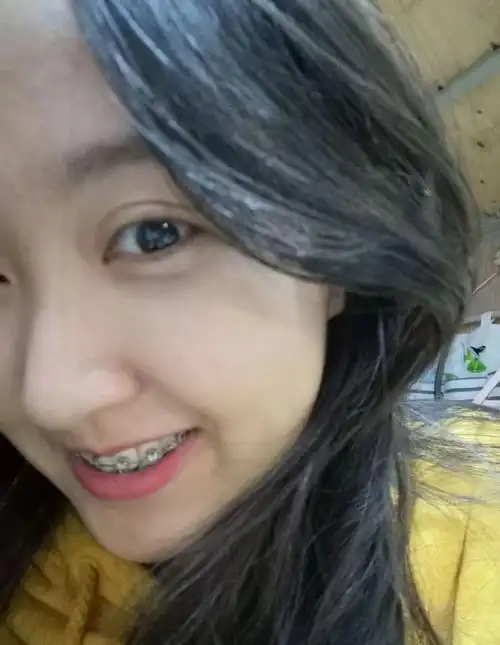 虎牙妹妹矫正前后对比