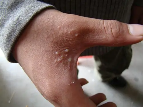 疥疮- 皮肤及性传播疾病讨论版 - 爱爱医医学论坛