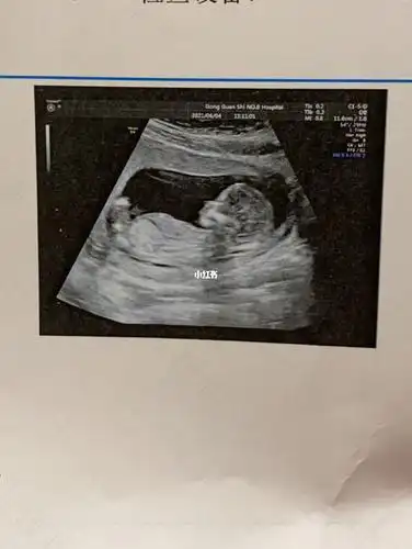 14周2nt结果还有参考意义吗12周2nt值多少为正常