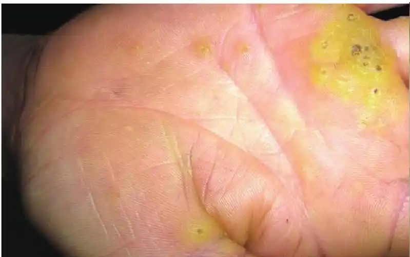 第五节点状掌跖角皮症