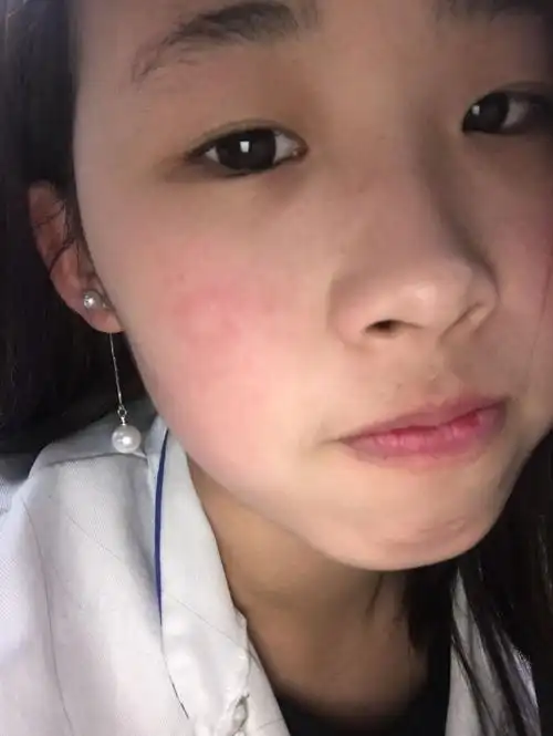 脸上红血丝下不去怎么办?