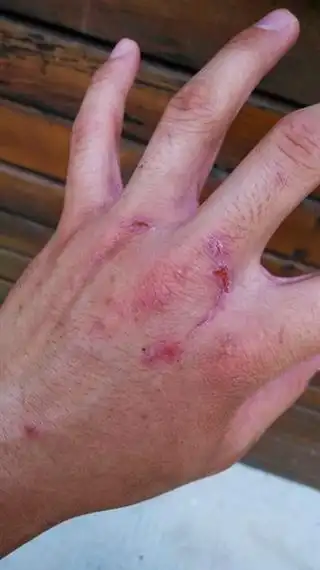 被熊猫攻击后郭靖鹏手上留下的伤痕.