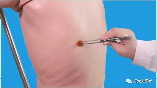 【每日技能】胸腔穿刺术操作步骤,考试注意事项