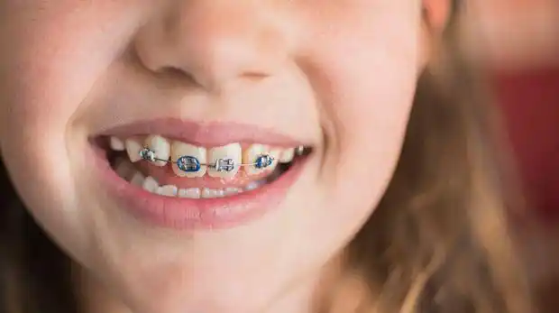 儿童在矫正牙齿的时候不适合吃什么食物