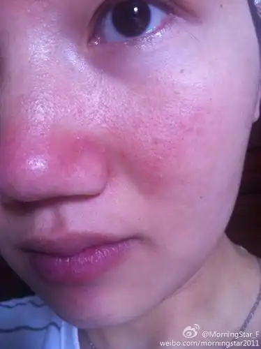 脂溢性皮炎脸部能自愈吗(脂溢性皮炎一辈子都不能根治)