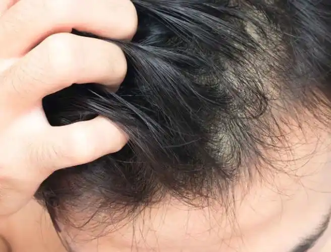 如何解决头皮敏感头皮敏感注意事项