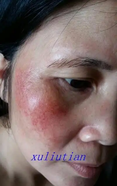 面部过敏怎么办,秋冬简单美白皮肤的方法