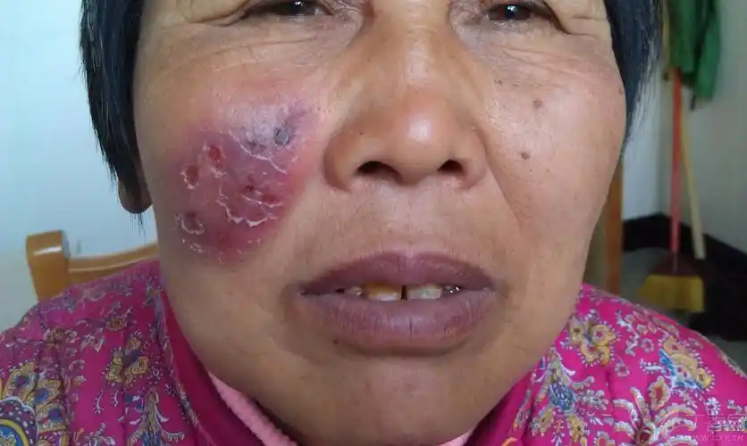 【请教】右面颊皮疹3年余,求诊断 - 皮肤性病 -丁香园论坛