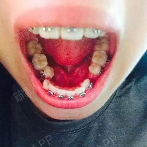 天生缺一颗侧切牙门牙偏歪左右不对称拔了三颗牙上面一_圈子-新氧美容