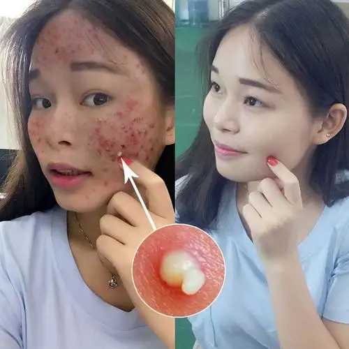 祛痘膏快速青春痘淡化去痘印痘疤痤疮修复凹洞祛痘坑霜_7折现价68元