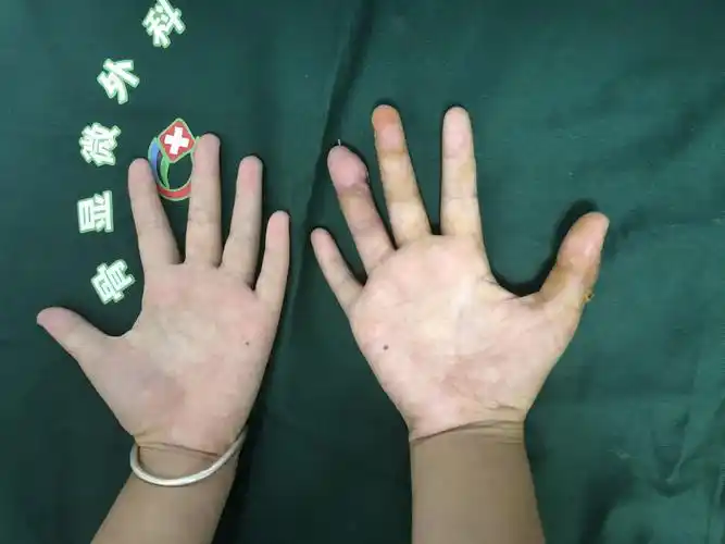 "神奇的外科医生帮我女儿再造手指"