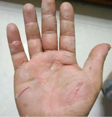 鹅掌风治疗药你知道几个