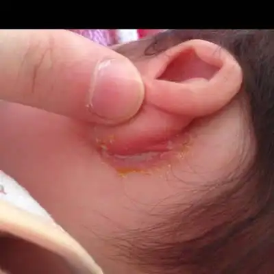 宝宝耳朵背后有点发红还有黄色的东东是不是湿疹了,有懂的宝妈给点