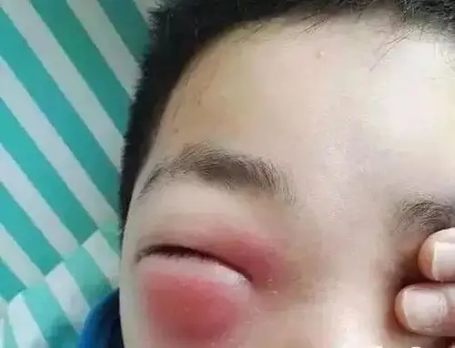 眼睛肿是什么原因