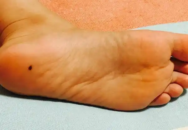 答案是肯定的,也就是说脚底有痣的女人是好,女人是富贵的女人,她们