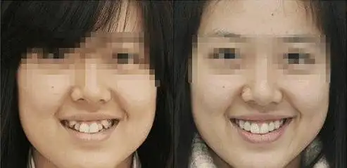 它是帅哥美女的标志,为何不少明星却要拔了它?_虎牙