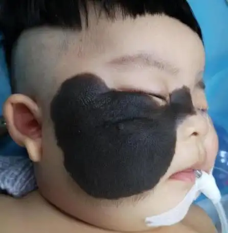 怎么治疗黑毛痣才是正确的方法呢?