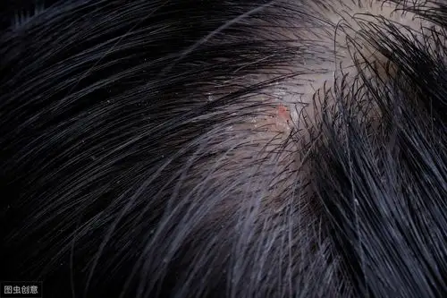 头皮痒掉头发是什么原因