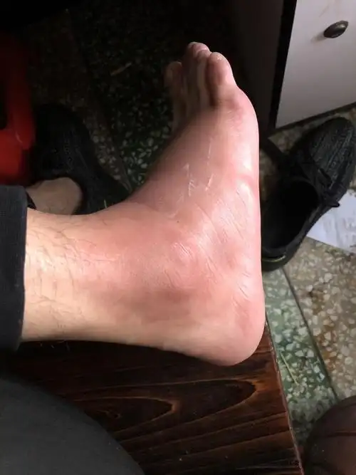 被飞虫咬到脚,红肿痒怎么办?