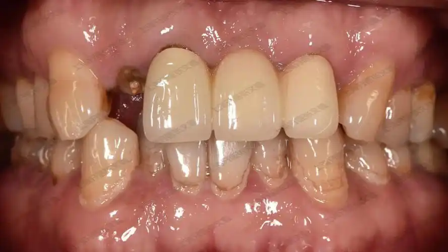 38即刻拔除即刻种植的种植牙修复案例
