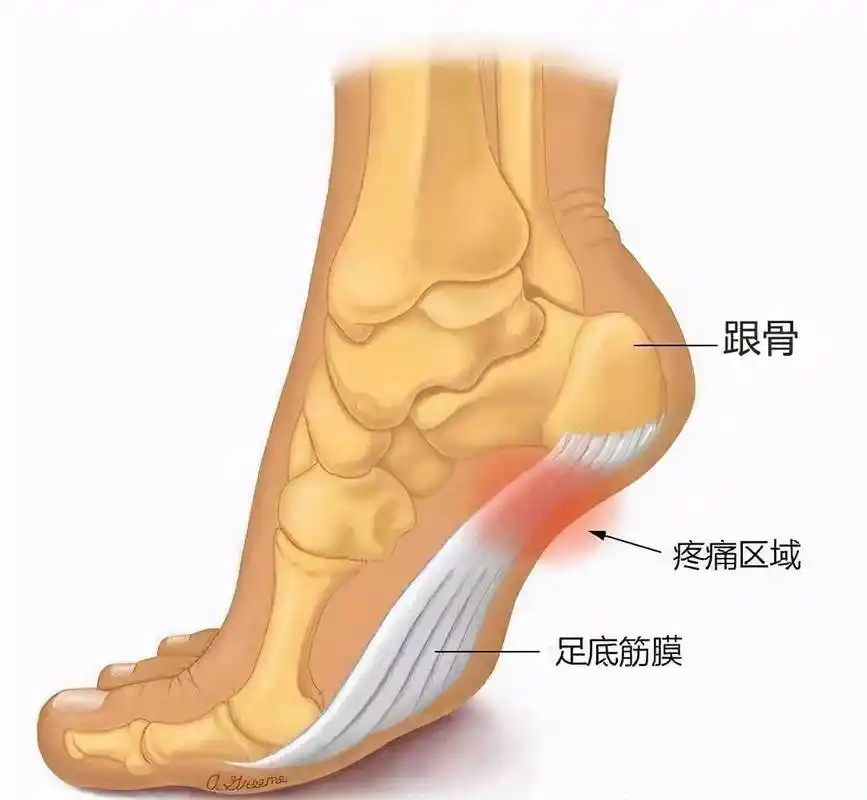 脚底疼痛是什么原因足底筋膜炎4个痛点