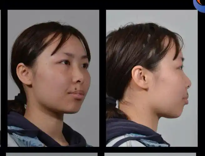 整牙前后对比图.侧面对比来啦