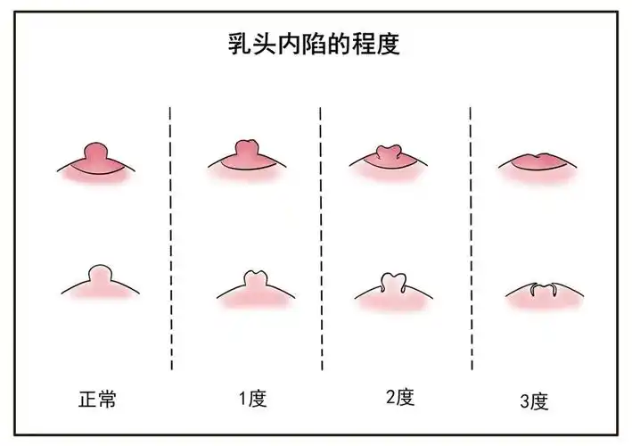 乳头内陷_介绍_发病原因_症状表现_治疗方式_日常注意事项 - 好大夫