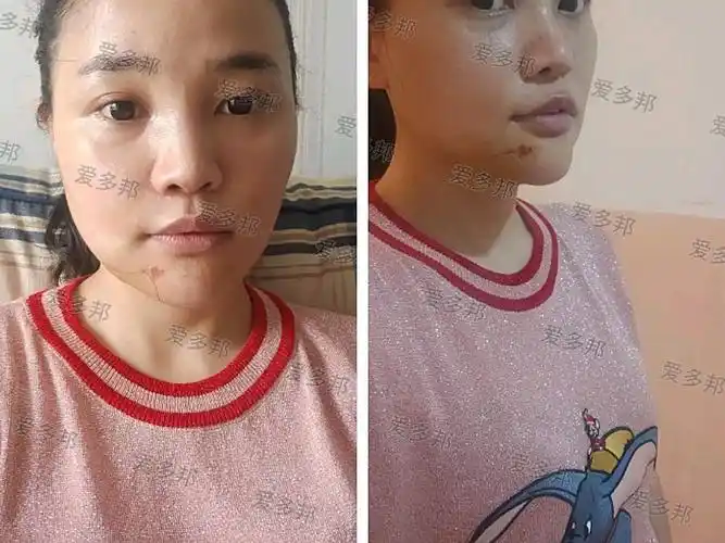 下巴生长因子取出术后3天反馈!