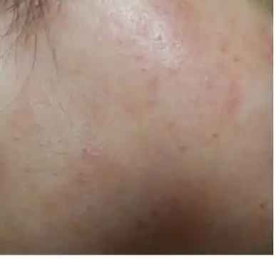 我用了化妆品(浪漫香榭丽3号),脸部皮肤过敏,怎么办?